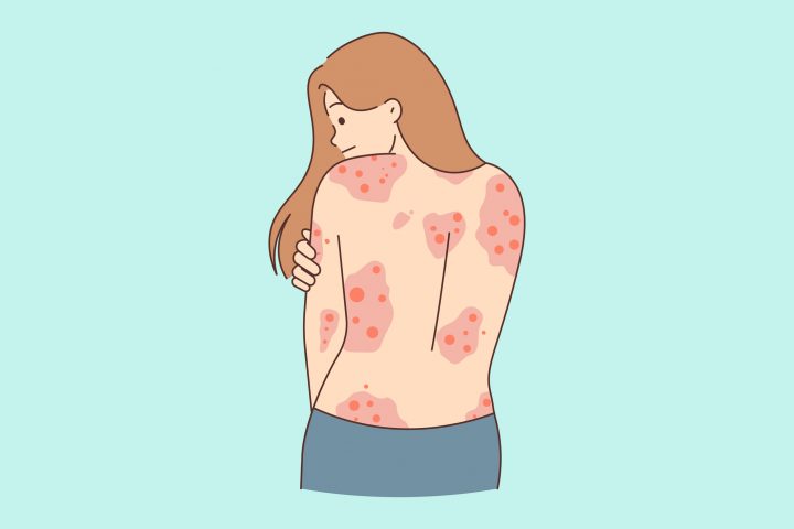 Más de 14 mil personas están afectadas por psoriasis en Chile