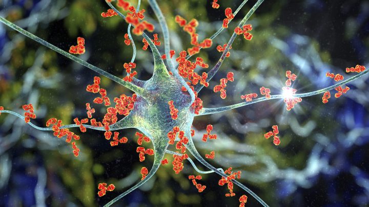 Crean IA que predice la evolución de la esclerosis múltiple