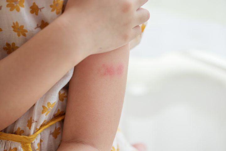 Picaduras, quemaduras solares y deshidratación: ¿Cómo prevenir las urgencias de verano?