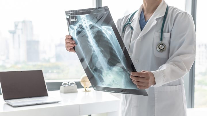 Científicos chilenos adaptan IA que predice el cáncer de pulmón años antes de su aparición