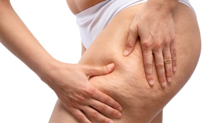 Investigadores chilenos desarrollan IA que diagnostica la celulitis con mayor precisión