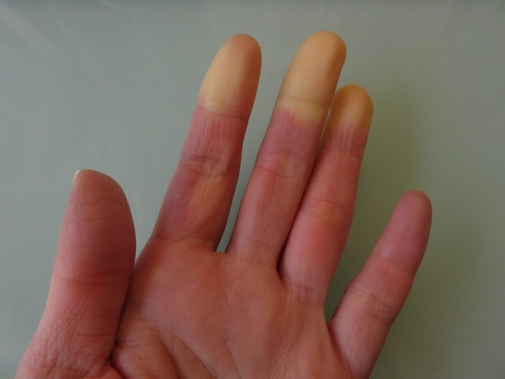Fenómeno de Raynaud: Cuando el frío y el estrés afectan la circulación en extremidades