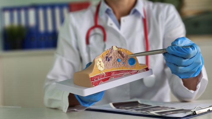 Estudio chileno advierte conexión entre la obesidad y el cáncer de mamas