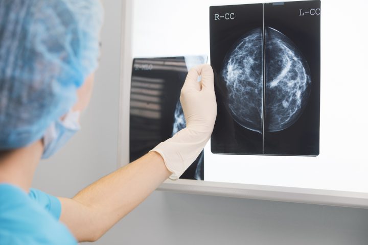 Minsal incorpora la primera inmunoterapia contra el cáncer de mama triple negativo