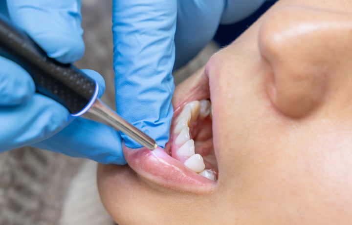 Carillas y blanqueamiento dental: especialistas llaman a priorizar la salud bucal por sobre la estética