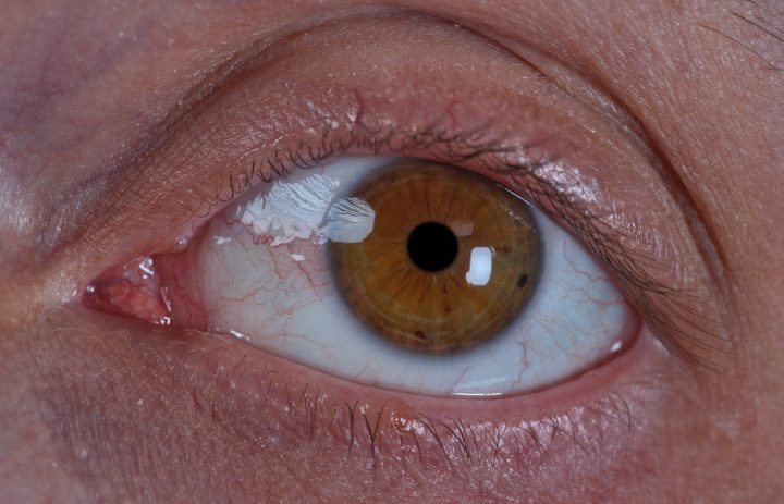 Síntomas y tratamientos del tumor ocular, un cáncer agresivo de detección tardía