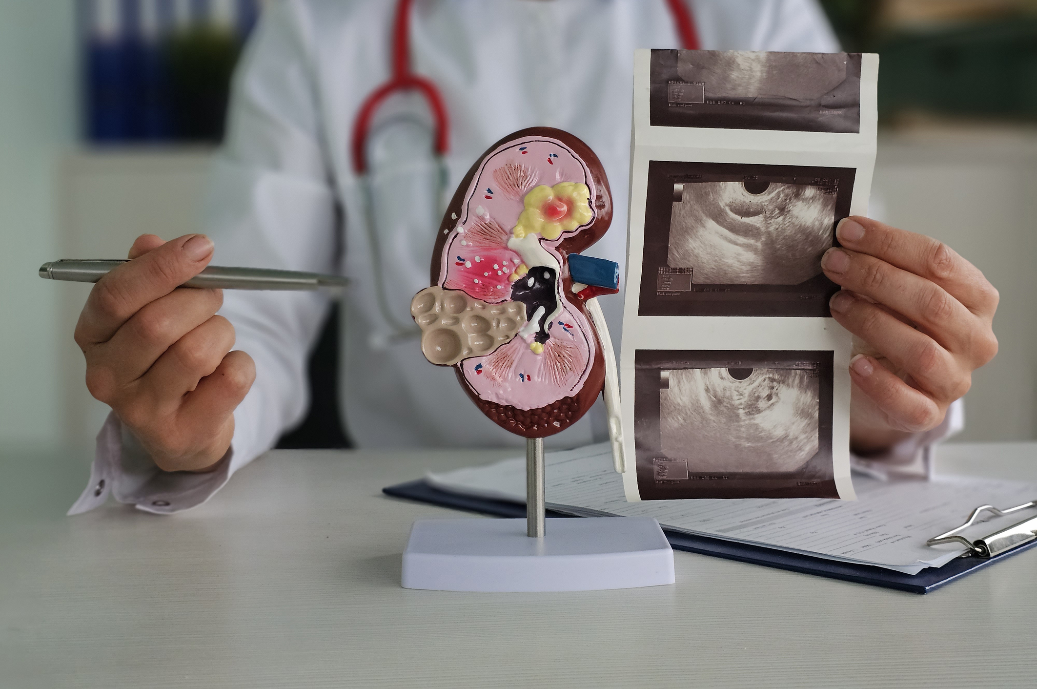 Investigadores identifican biomarcador para anticipar el daño renal agudo