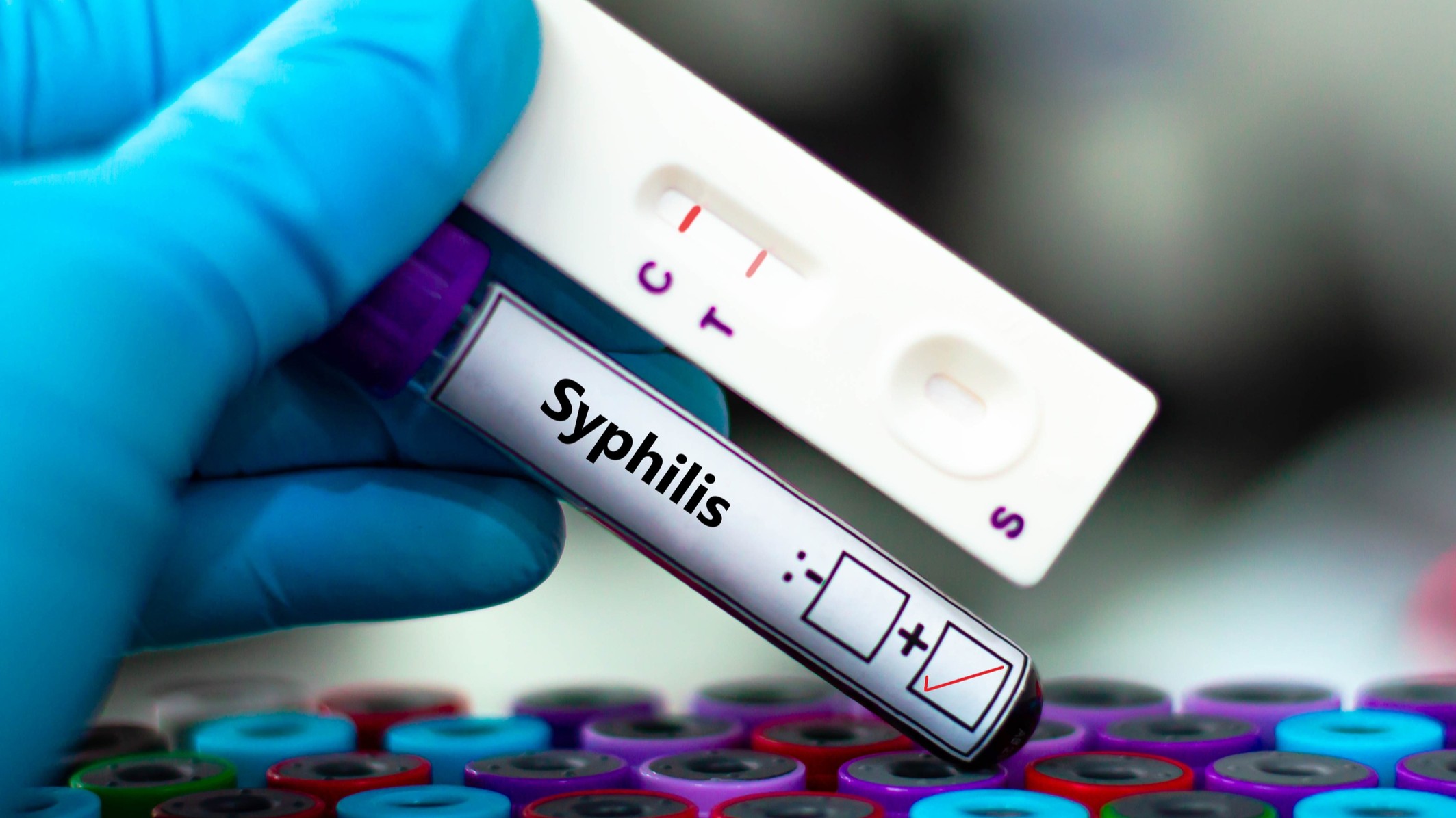 Alza de sífilis y gonorrea en Chile: Infectóloga alerta sobre falta de prevención y educación sexual